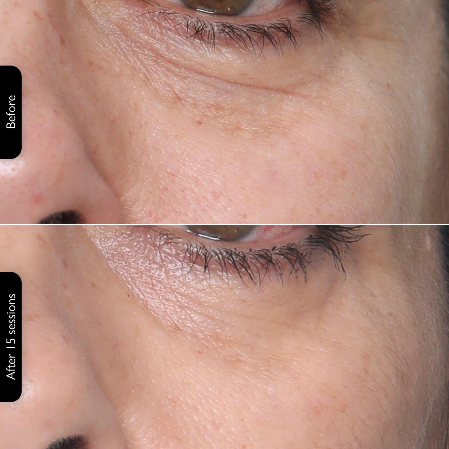 Silk’n Titan MultiPlatform H2502 Radiofrecuencia Facial y Corporal Reafirma, Reduce Arrugas y Mejora Firmeza de la Piel Dispositivo Antiedad en Casa